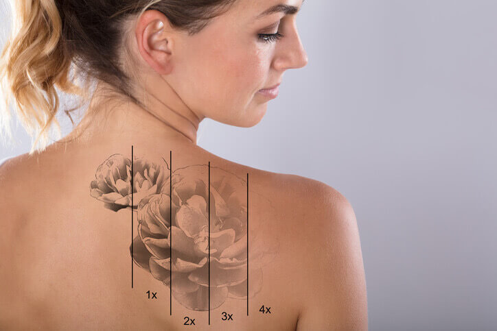 tattoo removal services