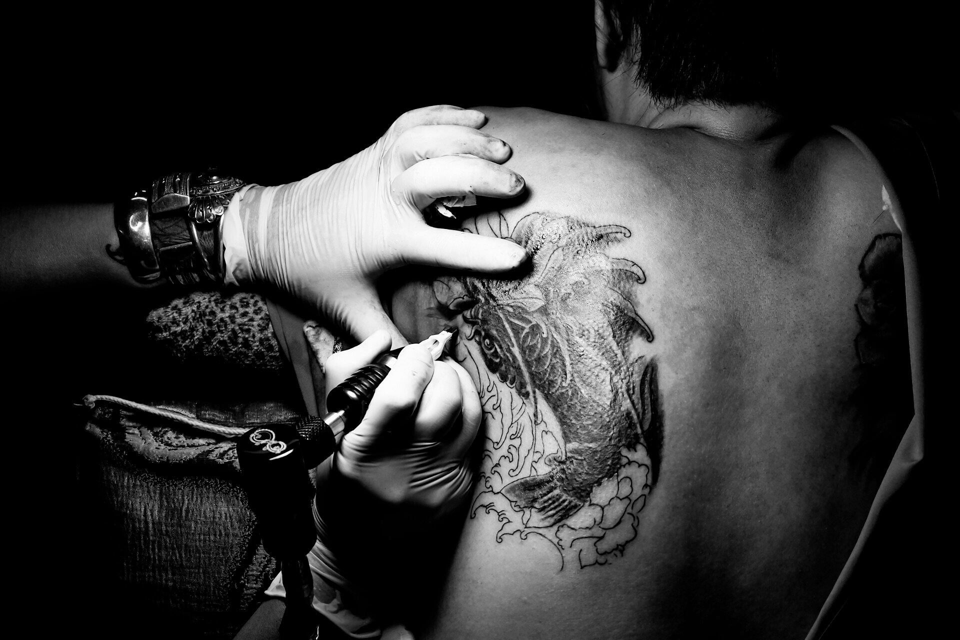 laser tattoo removal