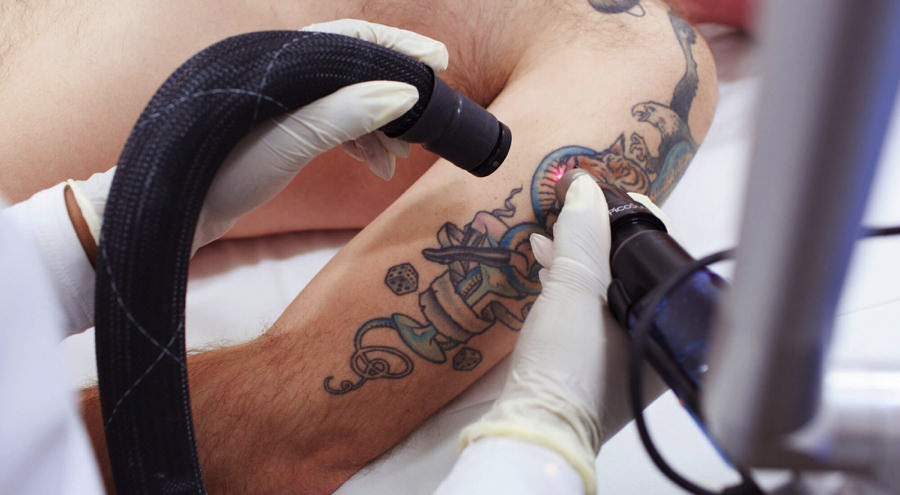 laser tattoo removal
