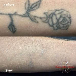 tattoo removal before and after