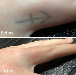 Tattoo Removal Cost