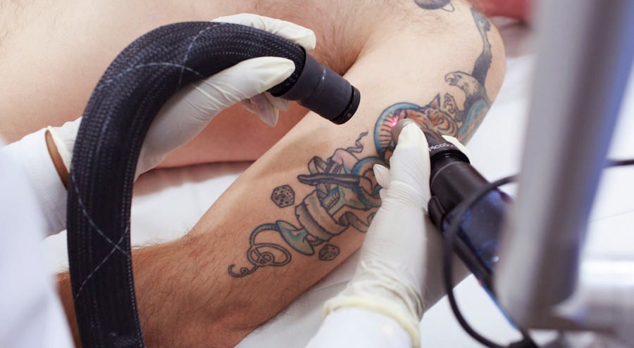 Laser tattoo removal